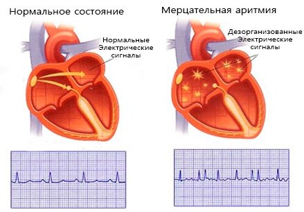 Лекарства при мерцательной аритмии сердца