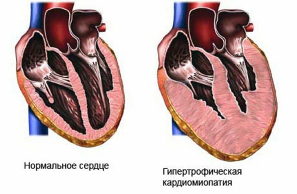 Гипертония правого желудочка сердца что это такое